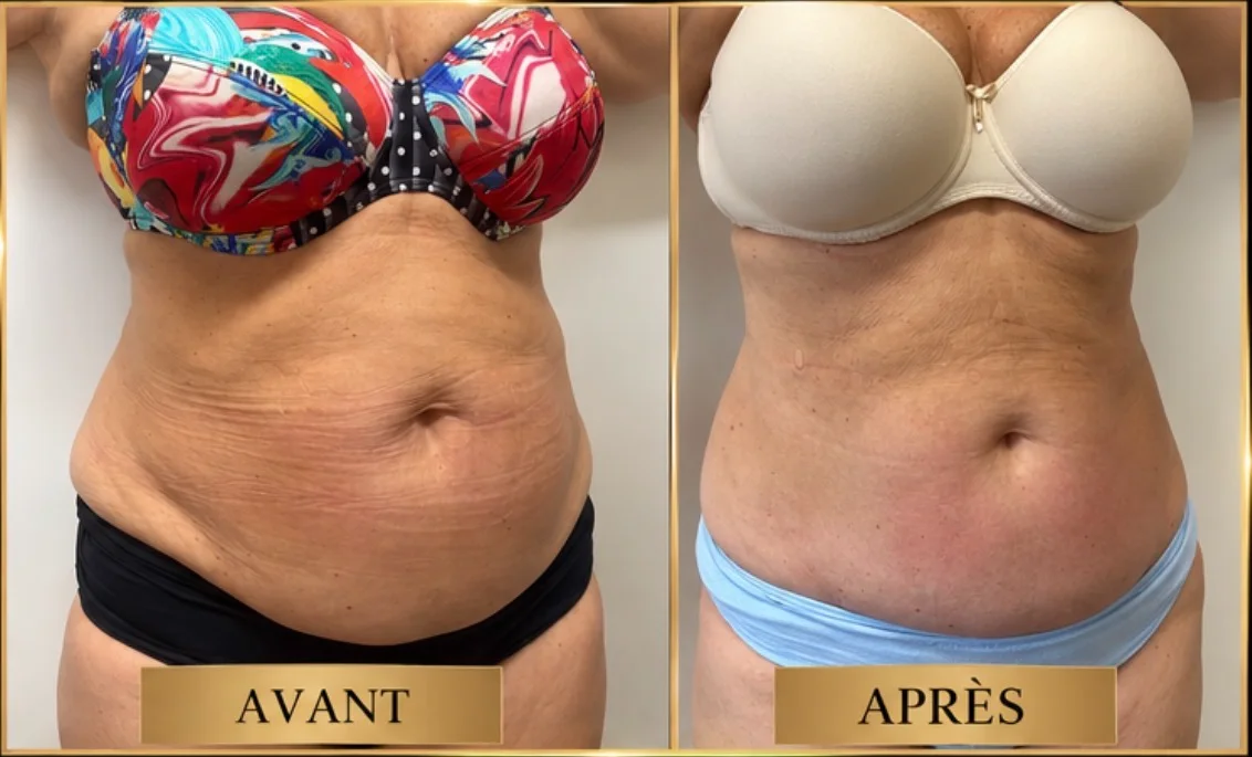 Avant et après une cryolipolyse sur l'abdomen