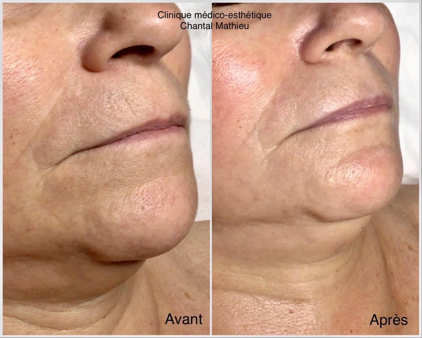 Avant et après un soin du visage à la clinique