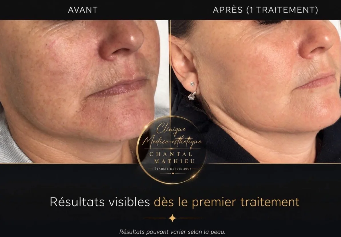 Résultat avant et après un traitement de la peau