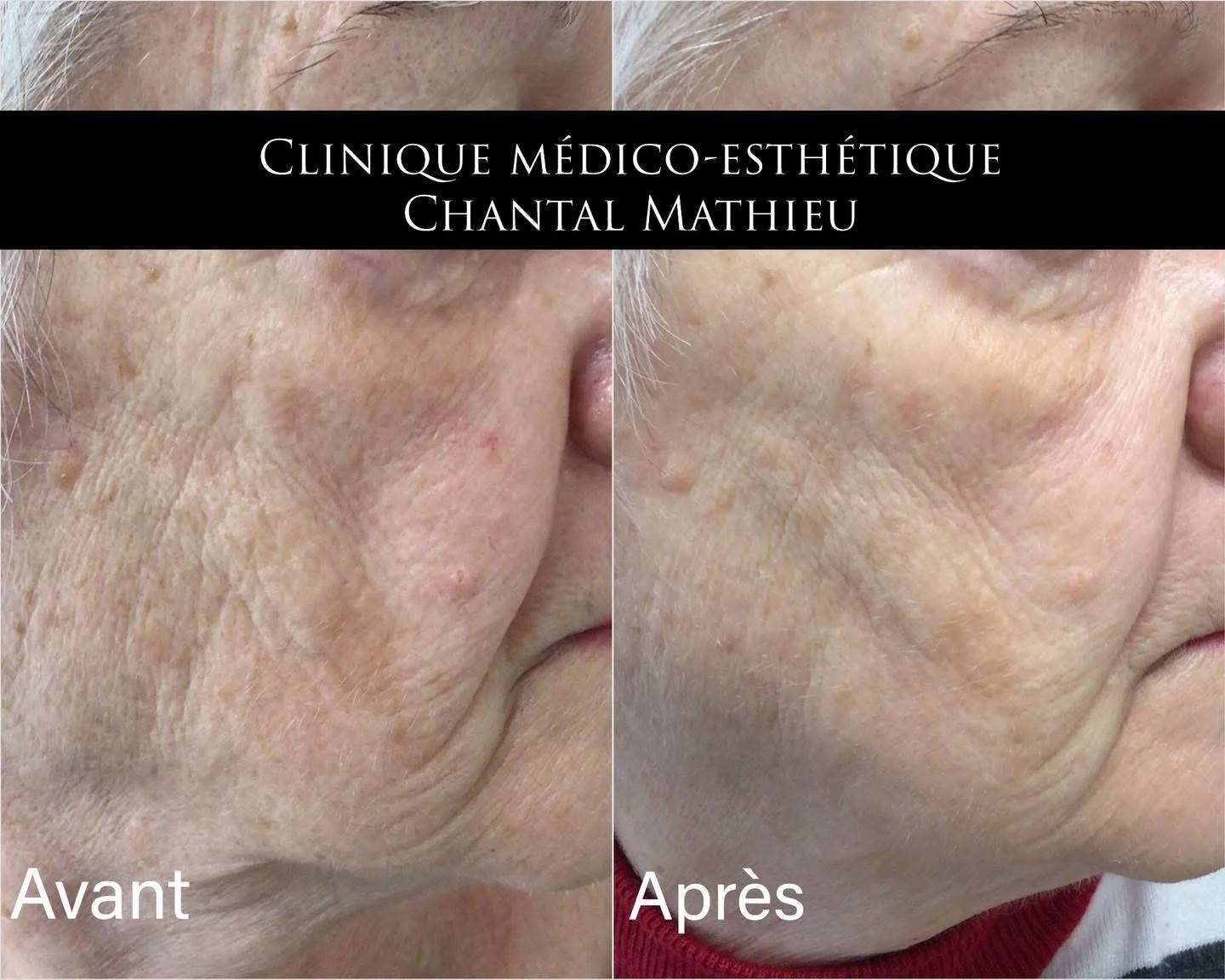 Avant et après un traitement de rajeunissement cutané
