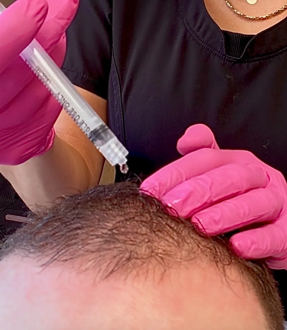 Injection de PRP capillaire sur le cuir chevelu